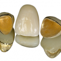 Dental Porcelain Gold Crown