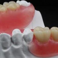 Flexible Partial Dentures